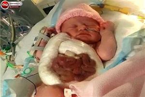 روده های این نوزاد خارج از شکمش است+عکس