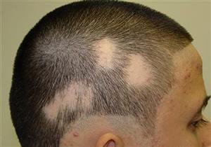 علل ریزش سکه‌ای مو چیست؟
