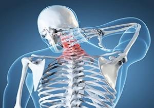 عواملی که باعث بروز آرتروز گردن می شوند!
