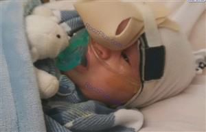 جراحی کودکی که مغزش در بین چشم هایش رشد کرده بود! +تصاویر
