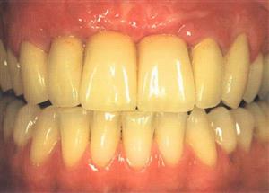 با این 6 ماده طبیعی دندانهایتان مثل طلا می درخشد
