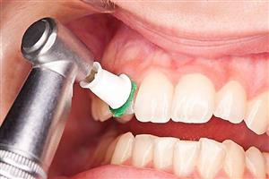 آیا جرم‌گیری دندان کار درستی است؟
