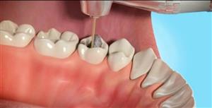 چه زمانی عصب‌کشی برای دندان‌ها لازم می‌شود؟
