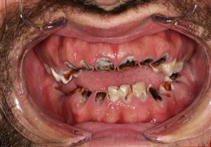 مردی که تمام دندان هایش را پای یک اعتیاد عجیب از دست داد +تصاویر
