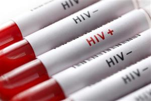 یک سوم افراد مبتلا به ایدز از بیماری خود اطلاع ندارند