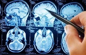 کشف دارویی جدید برای کاهش آسیب سکته مغزی 