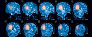 ایمونوتراپی؛ درمان تومورهای بدخیم مغزی